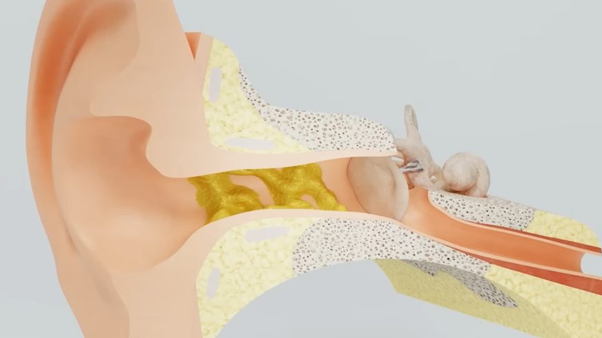 enlever bouchon cerumen