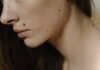 Quelles sont les principales causes des taches sur le visage ? tâche sur le visage