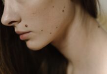 Quelles sont les principales causes des taches sur le visage ? tâche sur le visage