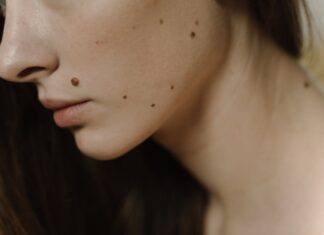 Quelles sont les principales causes des taches sur le visage ? tâche sur le visage